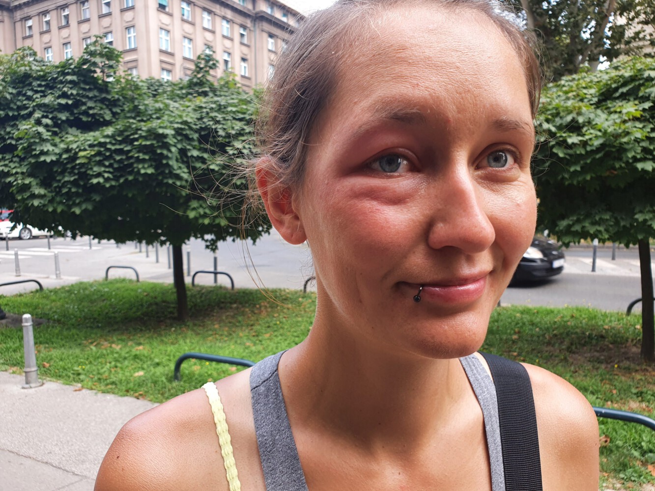 Alina with her swollen eye after the attack of an insect.